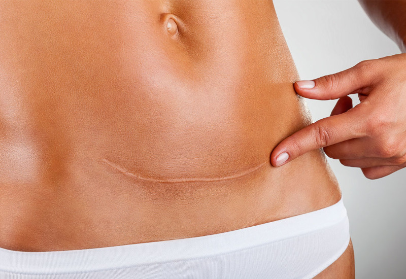 Ngứa vết mổ sau sinh