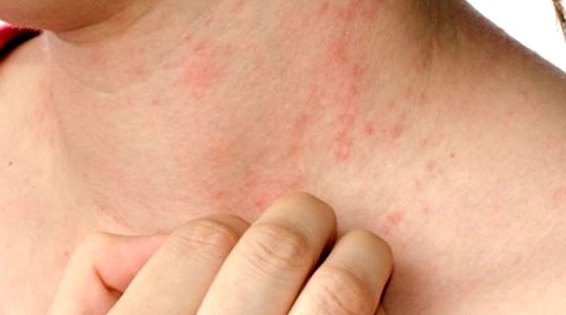 cách chữa mề đay sau sinh bằng nguyên liệu tự nhiên