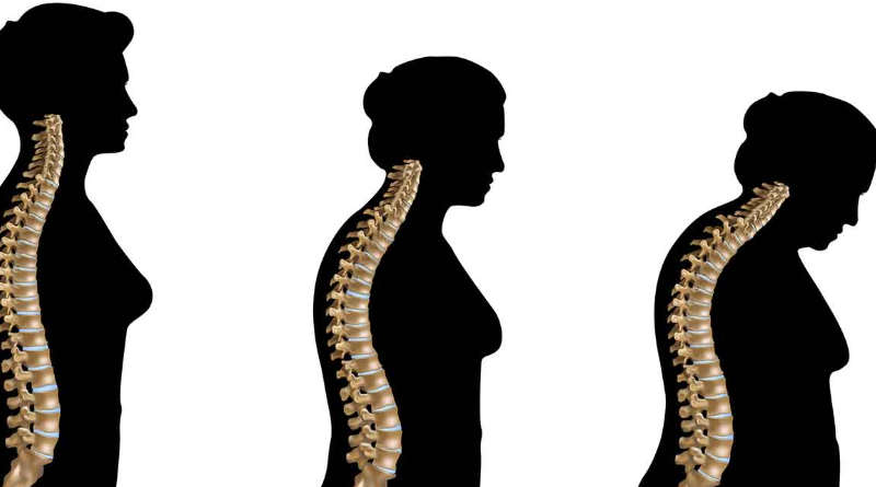 loãng xương ở phụ nữ