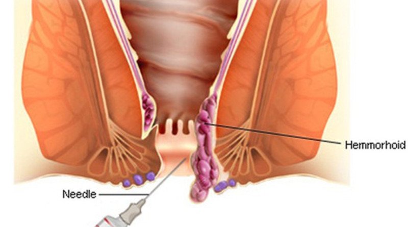 Dấu hiệu bị trĩ sau sinh