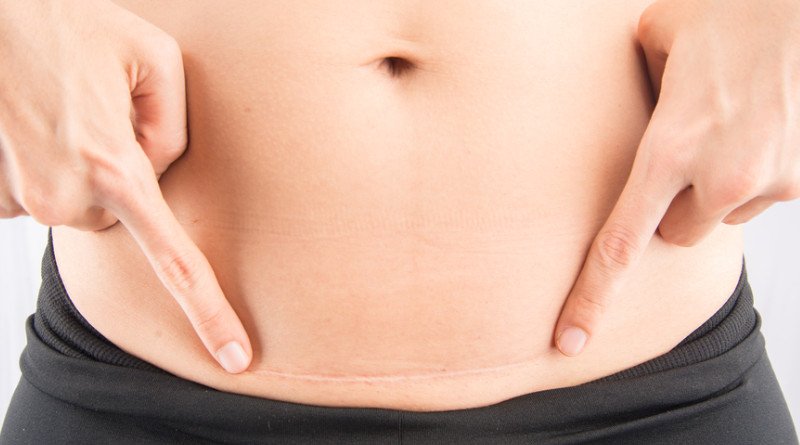 vết mổ sau sinh bị sưng