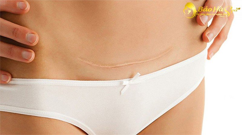 Cách khắc phục vết khâu tầng sinh môn bị lỗi