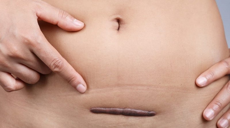 Những biện pháp giảm đau bụng dưới sau sinh giúp mẹ thoải mái hơn